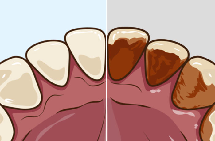 歯の着色汚れ