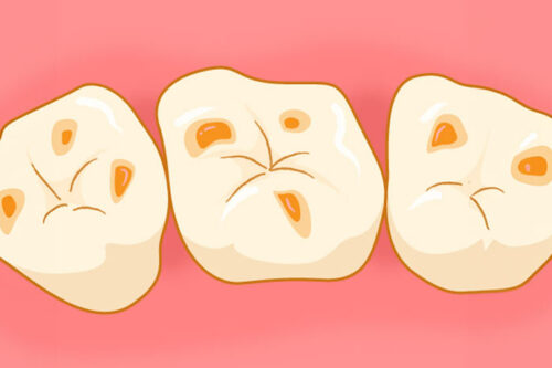 3月4日は「酸蝕歯の日」です!