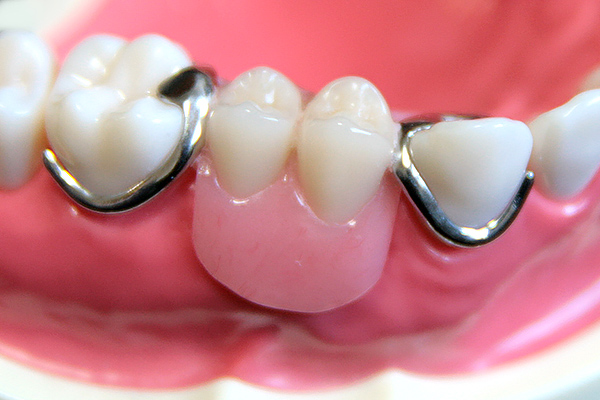 失った歯を補う治療